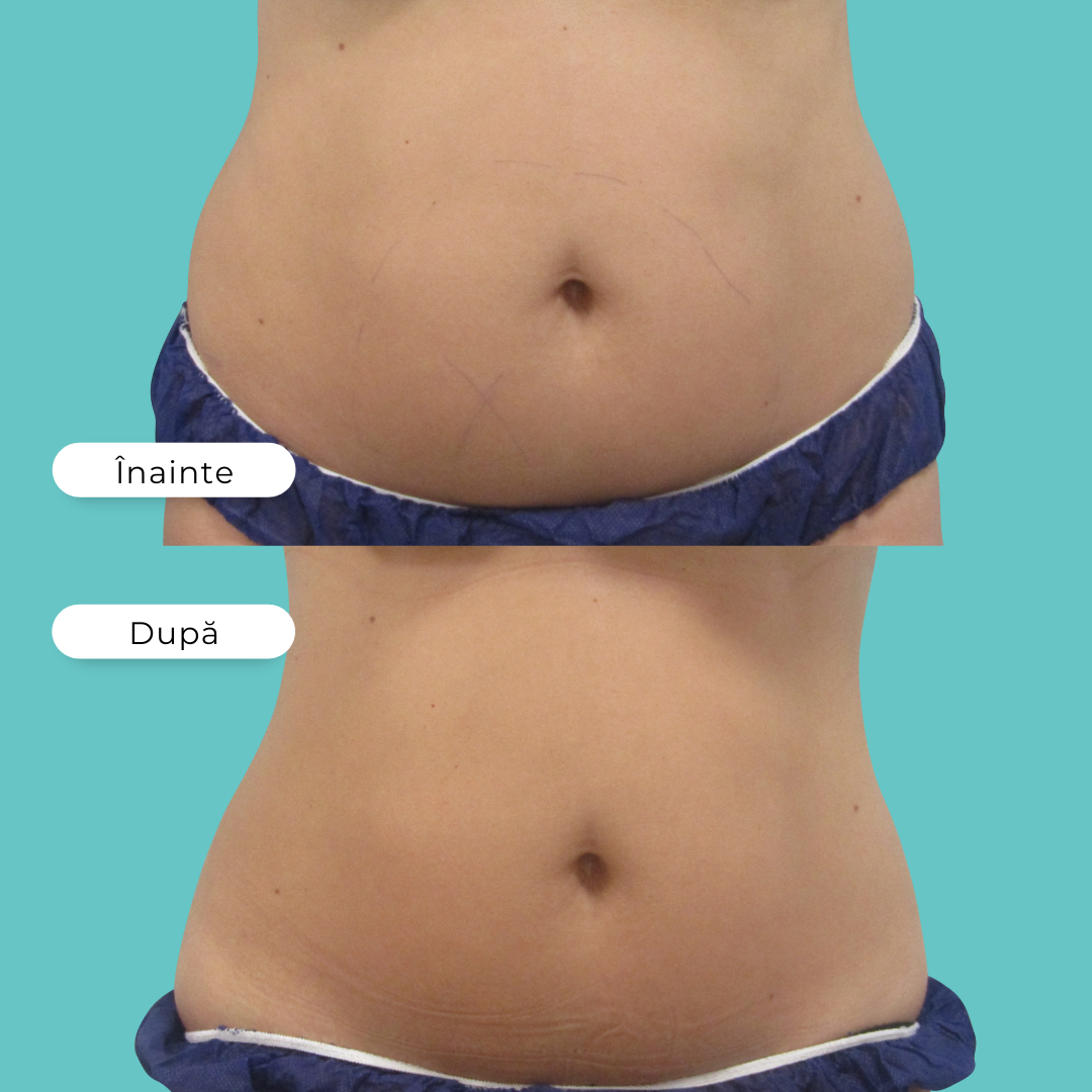 criolipoliza, cooltech , reducerea celulitei , reducerea grasimii, timisoara