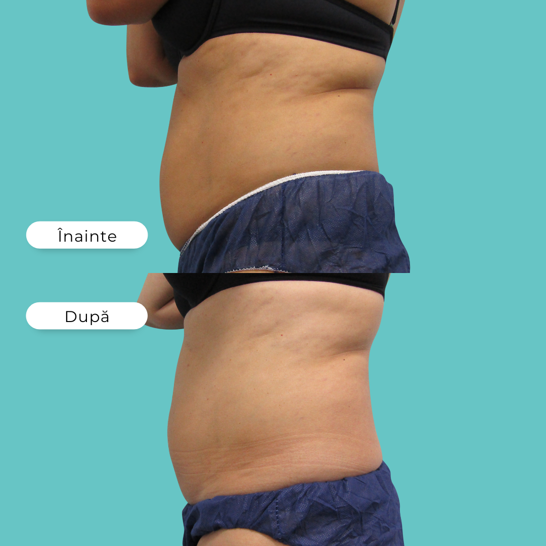 criolipoliza, cooltech , reducerea celulitei , reducerea grasimii, timisoara